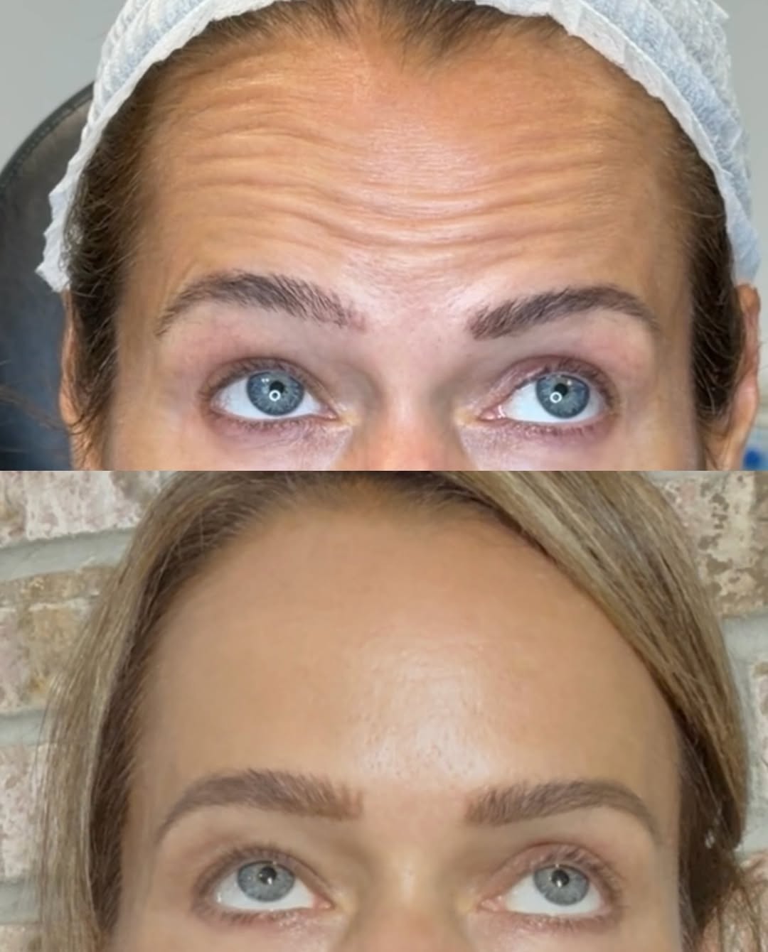 Forehead lines, brows raised, before and after, a patient of Dr. Adam Mauer