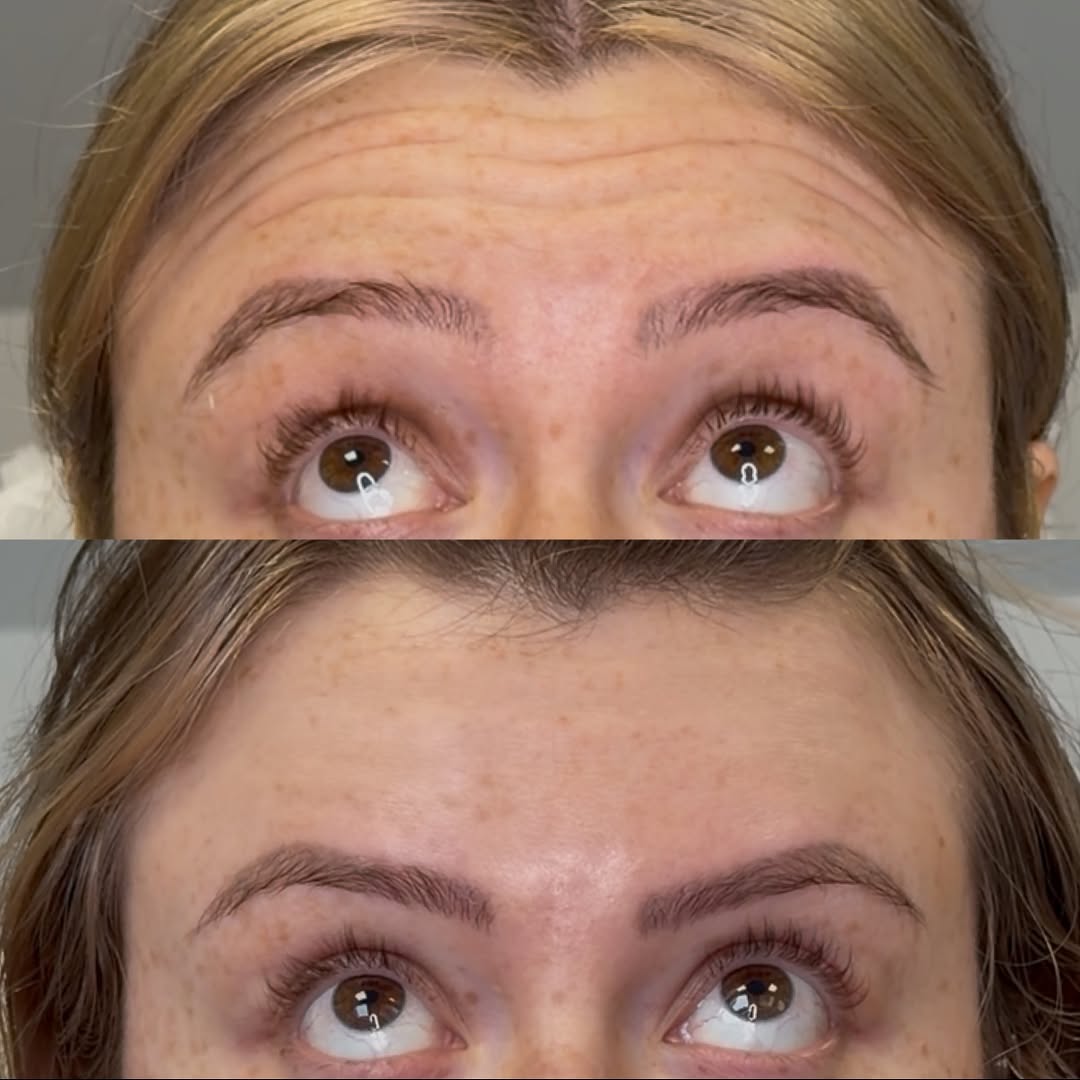 Forehead and brow, before and after, a patient of Dr. Adam Mauer