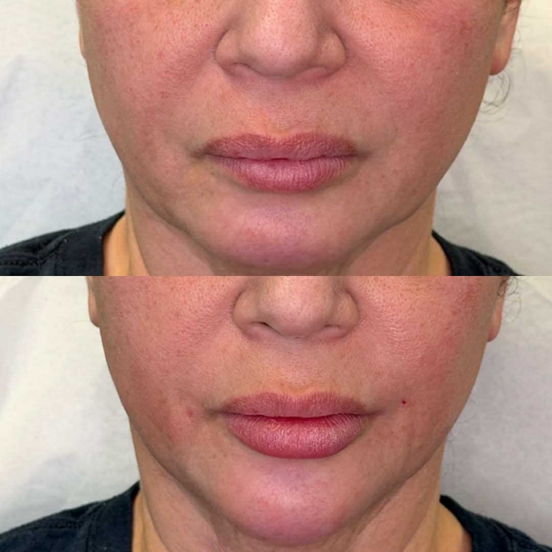 Volume and structure, before and after, a patient of Dr. Adam Mauer