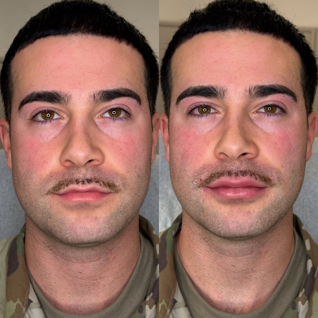 Male patient, definition, before and after, a patient of Dr. Adam Mauer