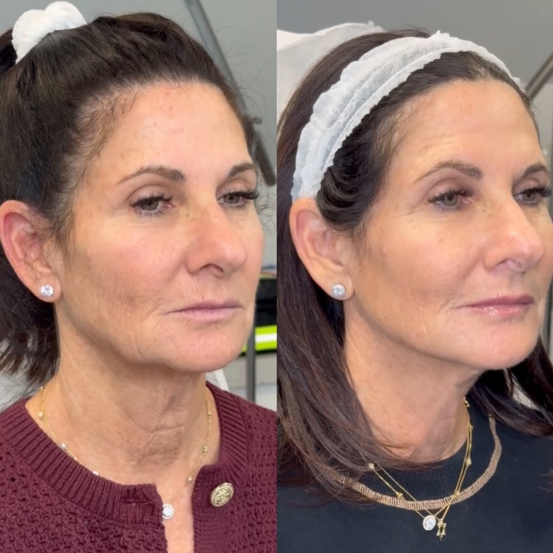 Thread lift with Botox and filler, before and after, a patient of Dr. Adam Mauer