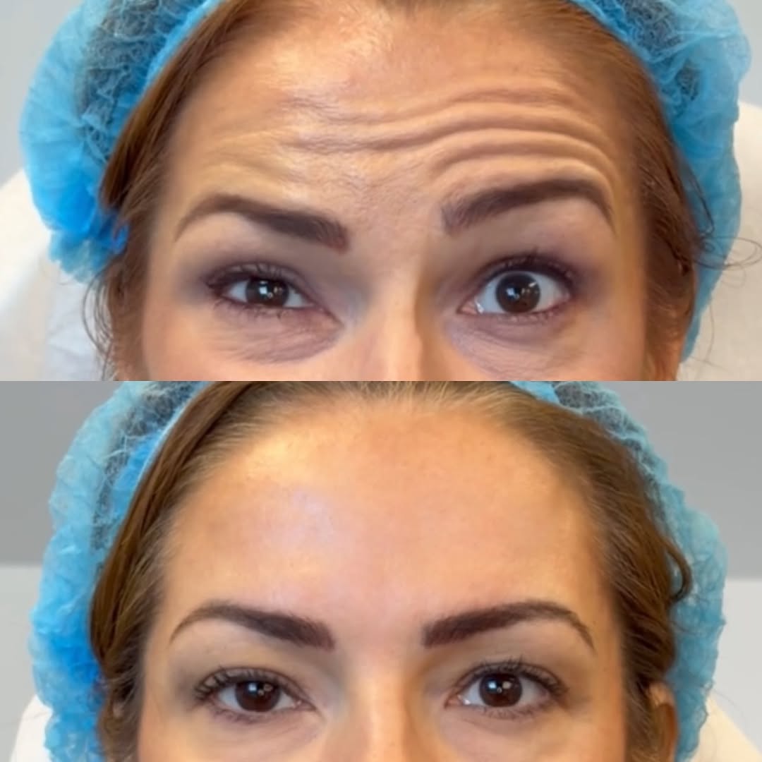 Bell's Palsy symmetry, before and after, a patient of Dr. Adam Mauer