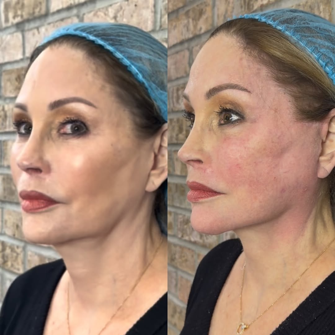 Immediate lift, before and after, a patient of Dr. Adam Mauer