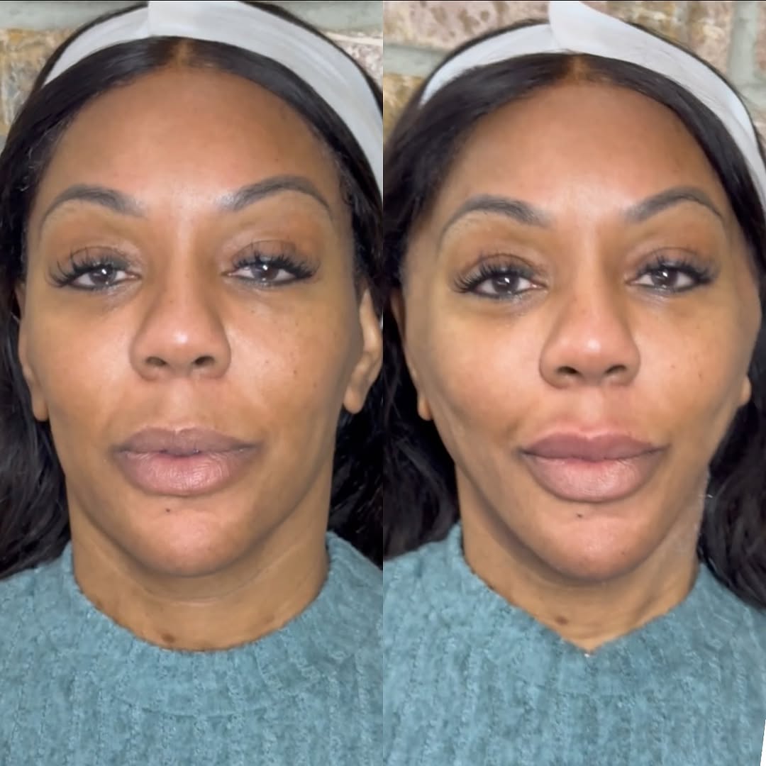 Thread lift, immediate, before and after, a patient of Dr. Adam Mauer