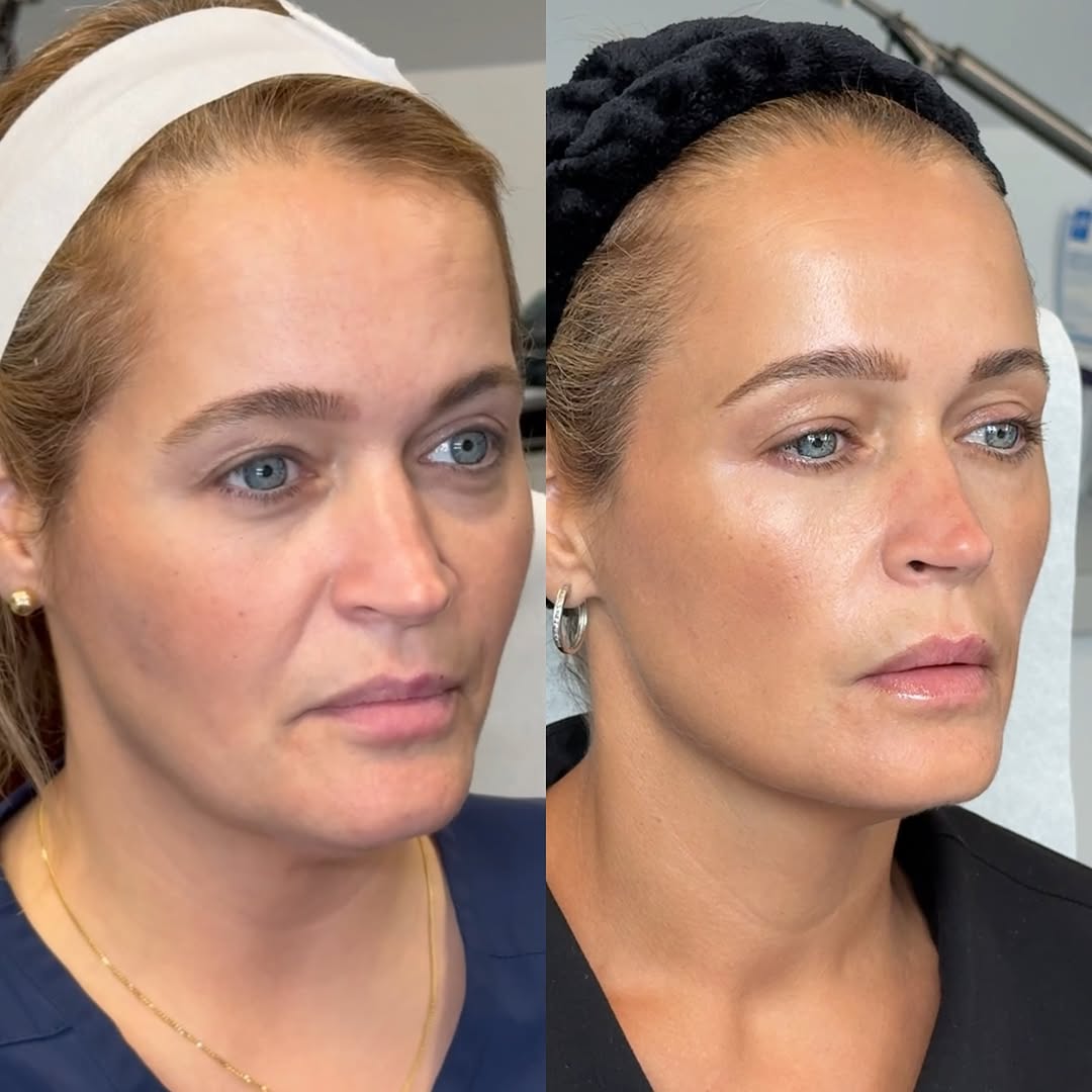 Ten years of treatment, before and after, a patient of Dr. Adam Mauer