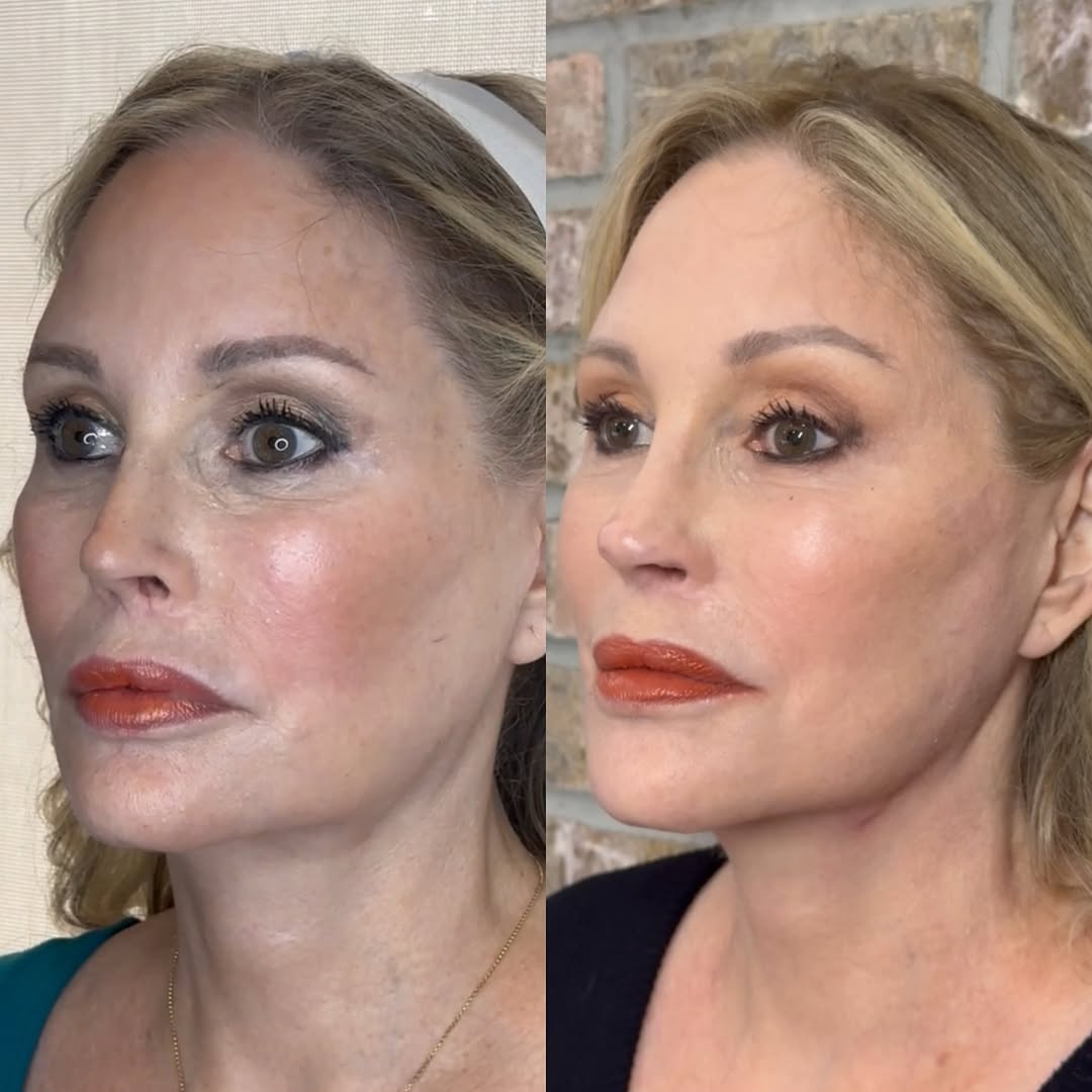 Thread lift instead of a revision facelift, before and after, a patient of Dr. Adam Mauer