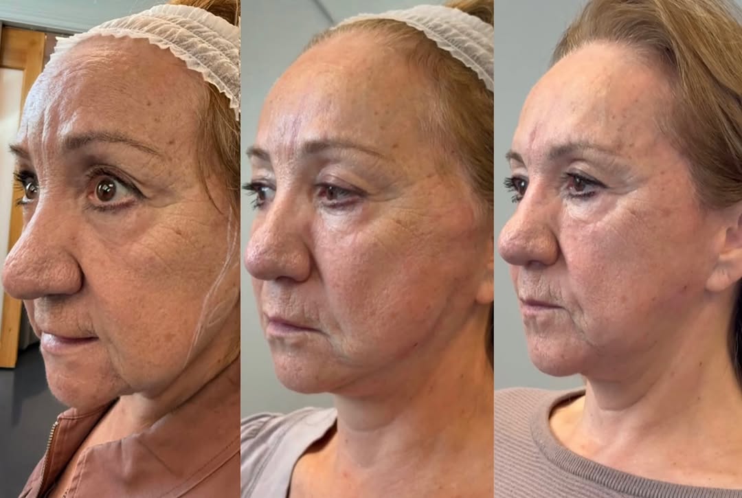 Threads, Botox, fillers, before and after, a patient of Dr. Adam Mauer